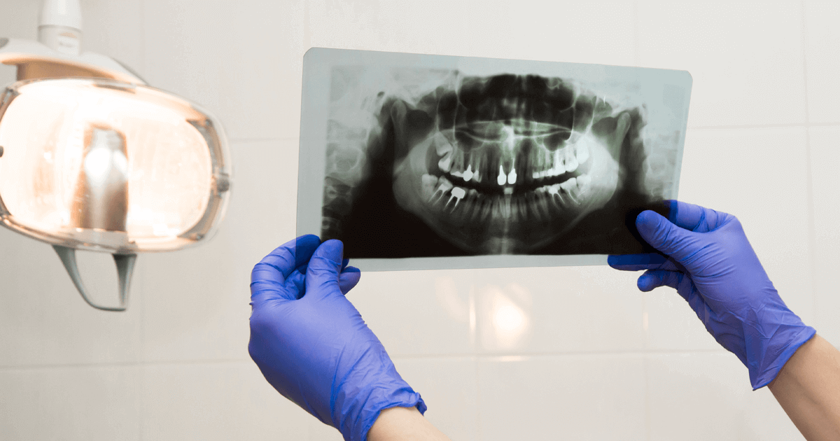 ake su podmienky pre uspesne zavedenie implantatov