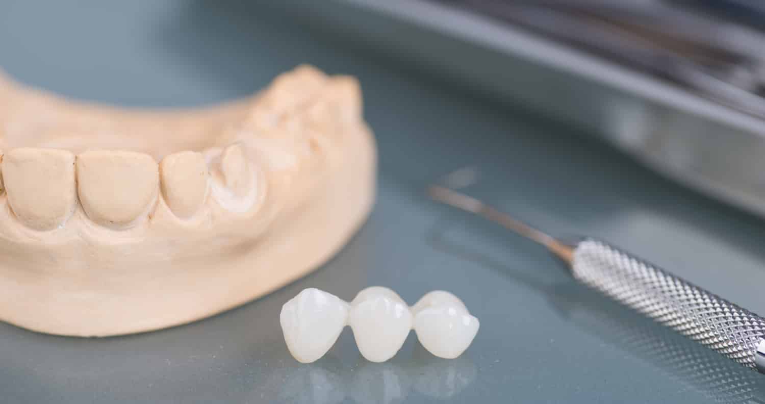 dental-bridge-oro-valley